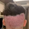 Saç ekimi sonuçları