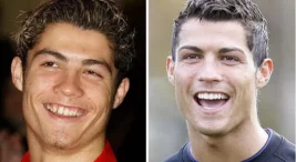 Zirkonyum Kaplama Yaptıran Erkek Ünlüler