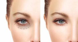 2026 Badem Göz Estetiği Yaptıranlar Yorumları: Fiyatlar ve Tüm Detaylar