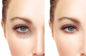 2026 Badem Göz Estetiği Yaptıranlar Yorumları: Fiyatlar ve Tüm Detaylar