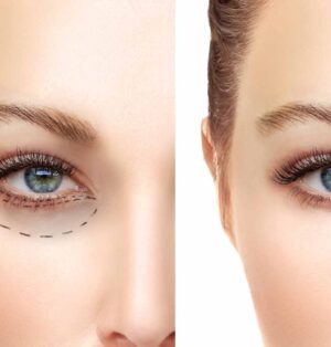 2026 Badem Göz Estetiği Yaptıranlar Yorumları: Fiyatlar ve Tüm Detaylar