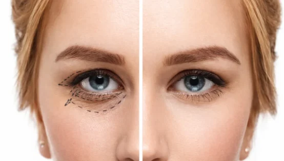 5 Altın Kuralla Göz Kapağı Estetiği (Blefaroplasti) İyileşme Rehberi