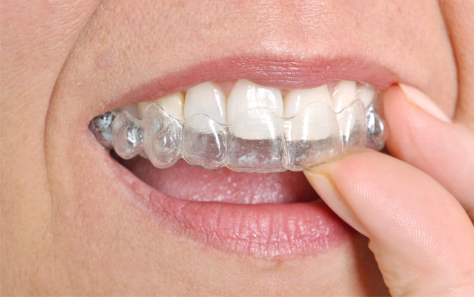 Diş Teli Yerine Şeffaf Plak Kullanan Ünlüler (Invisalign) : Tedavi Maliyetleri Ne Kadar?