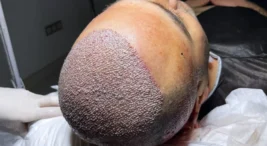 2026 Saç Ekimi Fiyatları: İstanbul’un En İyi Klinik ve Maliyetleri