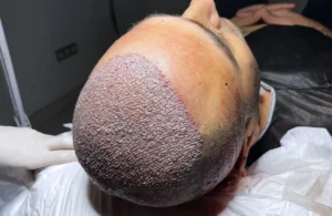 2026 Saç Ekimi Fiyatları: İstanbul’un En İyi Klinik ve Maliyetleri